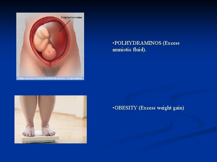  • POLHYDRAMINOS (Excess amniotic fluid). • OBESITY (Excess weight gain) 