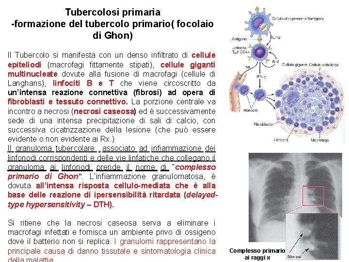 Tubercolosi primaria -formazione del tubercolo primario( focolaio di Ghon) Il Tubercolo si manifesta con