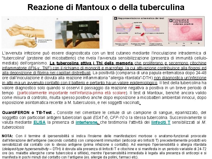 Reazione di Mantoux o della tuberculina L’avvenuta infezione può essere diagnosticata con un test