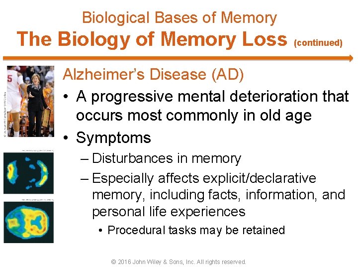 Biological Bases of Memory The Biology of Memory Loss (continued) Alzheimer’s Disease (AD) •