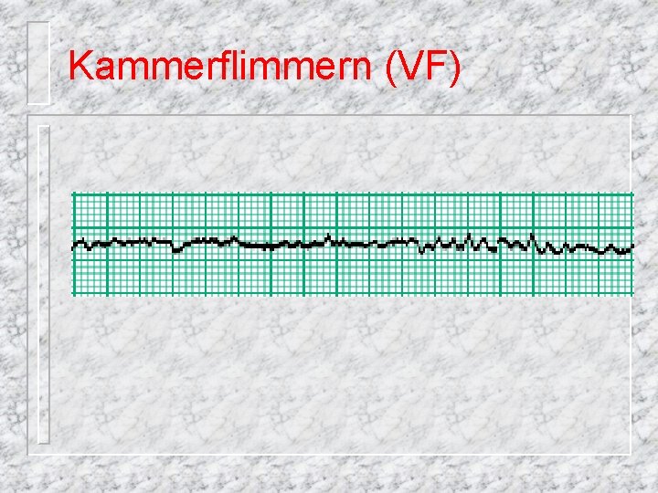 Kammerflimmern (VF) 