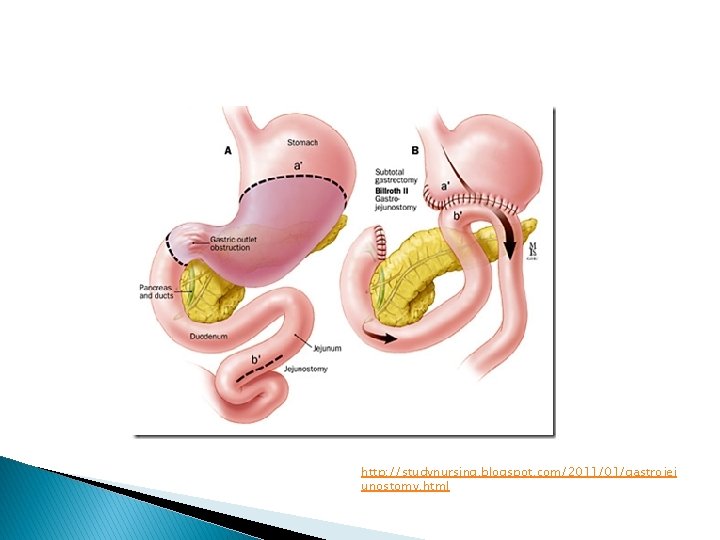 http: //studynursing. blogspot. com/2011/01/gastrojej unostomy. html 