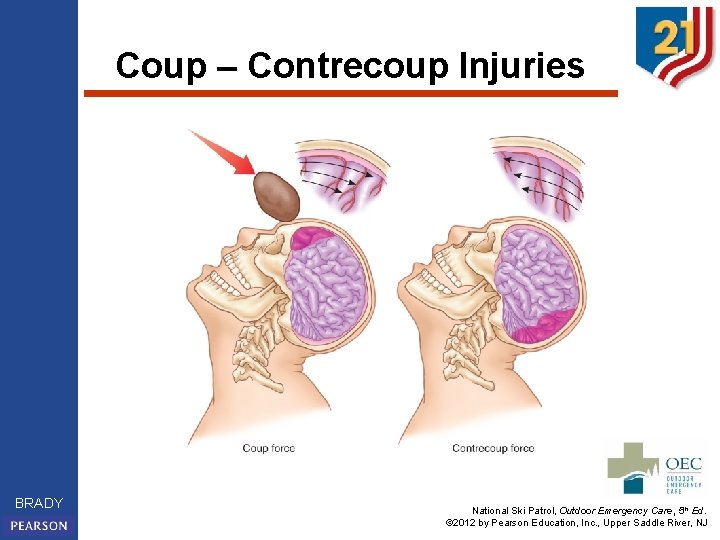 Coup – Contrecoup Injuries BRADY National Ski Patrol, Outdoor Emergency Care, 5 th Ed.