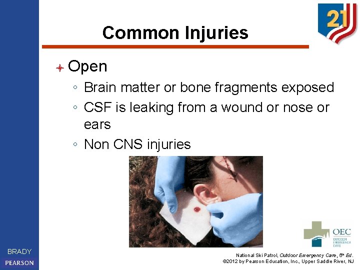 Common Injuries l Open ◦ Brain matter or bone fragments exposed ◦ CSF is