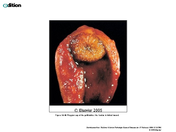 Figure 18 -48 Phrygian cap of the gallbladder; the fundus is folded inward. Downloaded