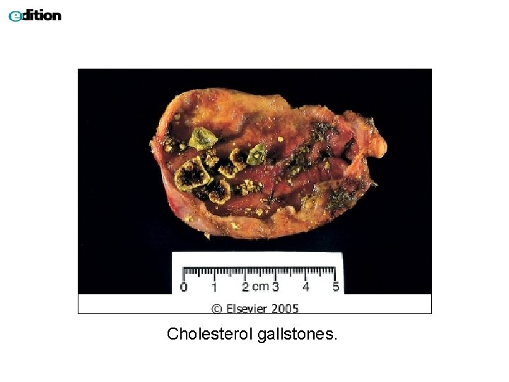 Cholesterol gallstones. 