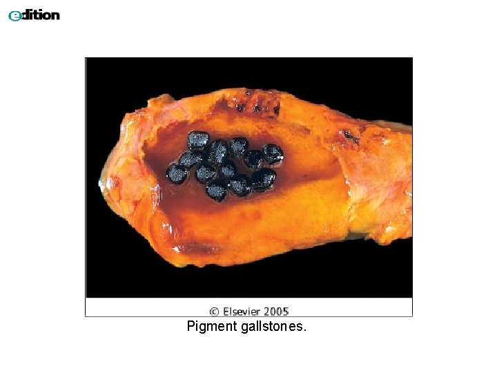 Pigment gallstones. 
