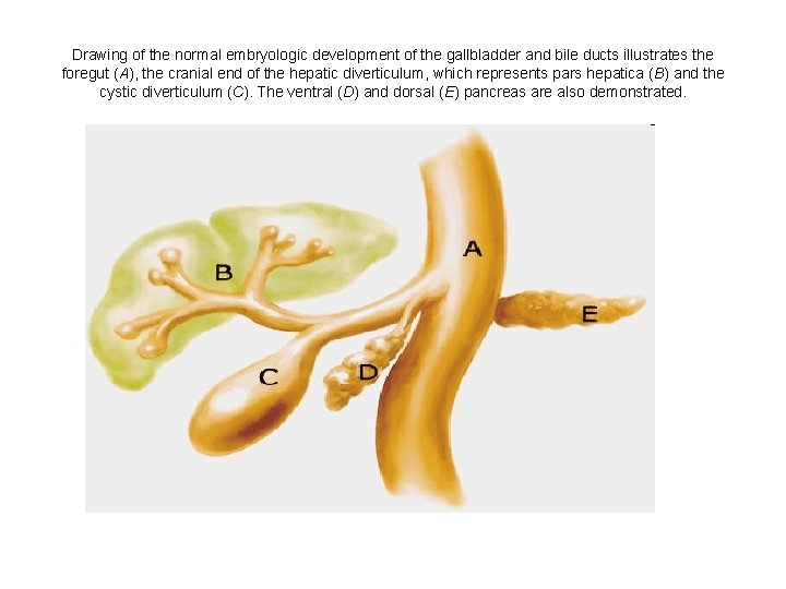 Drawing of the normal embryologic development of the gallbladder and bile ducts illustrates the