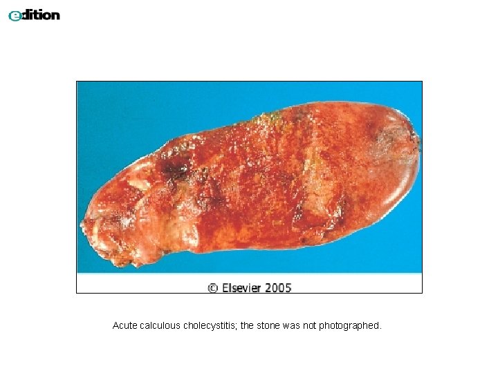 Acute calculous cholecystitis; the stone was not photographed. 