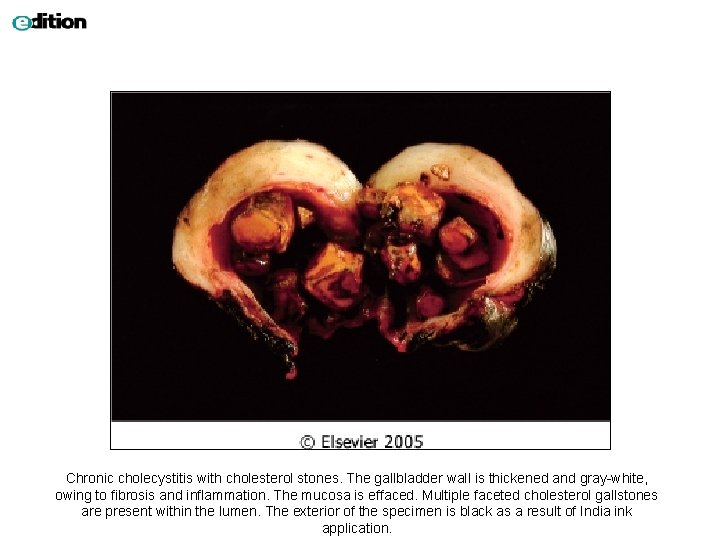 Chronic cholecystitis with cholesterol stones. The gallbladder wall is thickened and gray-white, owing to