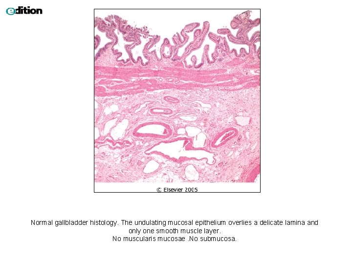 Normal gallbladder histology. The undulating mucosal epithelium overlies a delicate lamina and only one