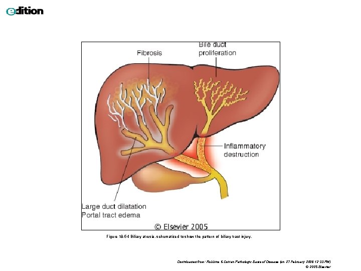 Figure 18 -54 Biliary atresia, schematized to show the pattern of biliary tract injury.