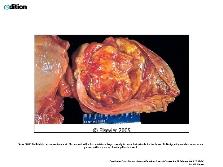 Figure 18 -55 Gallbladder adenocarcinoma. A, The opened gallbladder contains a large, exophytic tumor