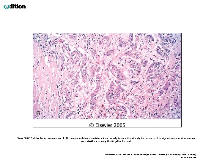 Figure 18 -55 Gallbladder adenocarcinoma. A, The opened gallbladder contains a large, exophytic tumor