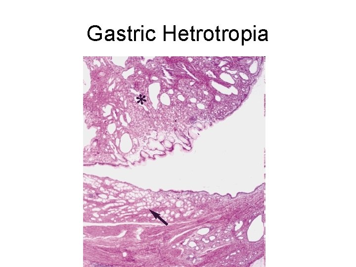 Gastric Hetrotropia 