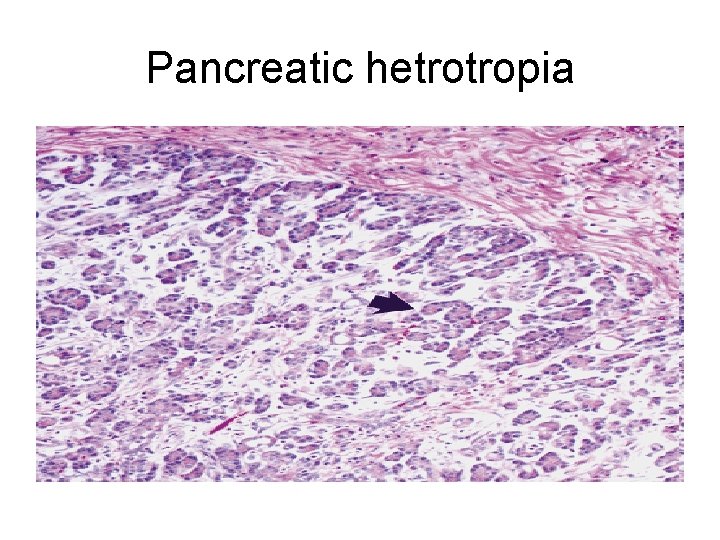 Pancreatic hetrotropia 