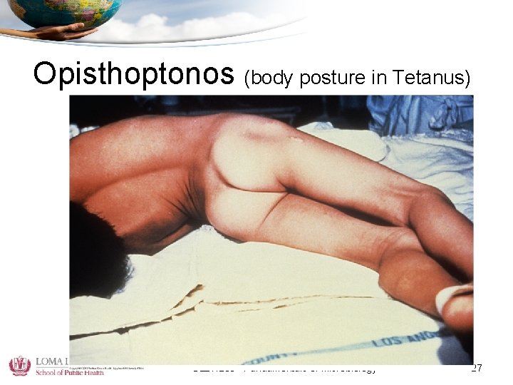 Opisthoptonos (body posture in Tetanus) GLBH 205 - Fundamentals of Microbiology 27 