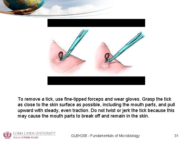 To remove a tick, use fine-tipped forceps and wear gloves. Grasp the tick as