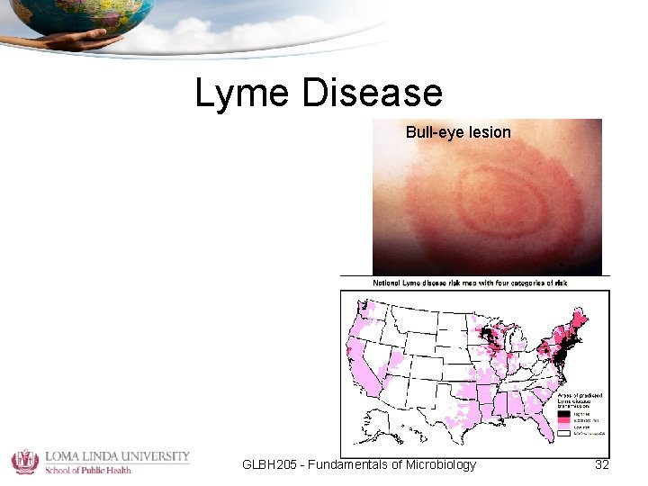 Lyme Disease Bull-eye lesion GLBH 205 - Fundamentals of Microbiology 32 