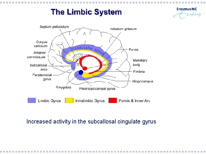  Increased activity in the subcallosal cingulate gyrus 
