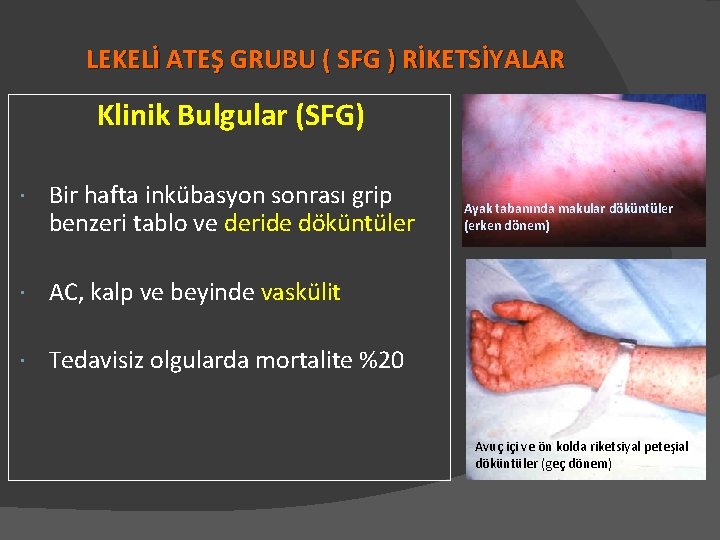 LEKELİ ATEŞ GRUBU ( SFG ) RİKETSİYALAR Klinik Bulgular (SFG) Bir hafta inkübasyon sonrası