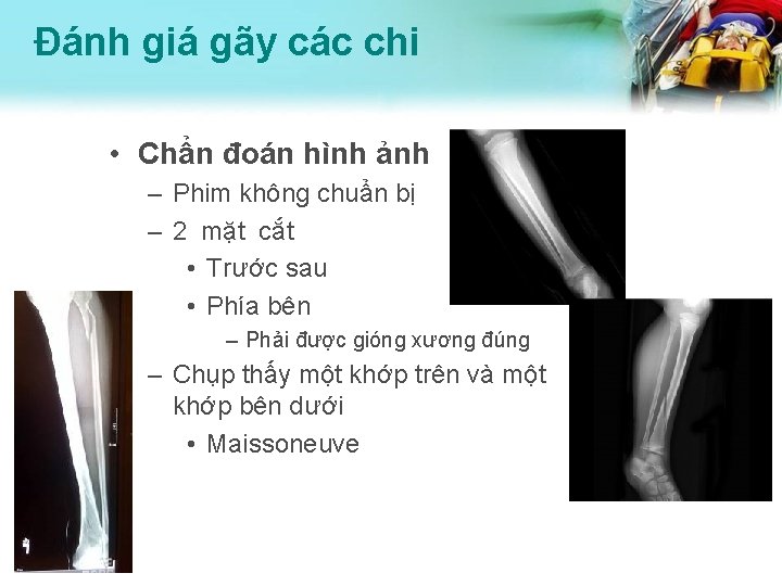 Đánh giá gãy các chi • Chẩn đoán hình ảnh – Phim không chuẩn