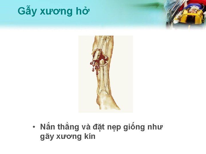 Gẫy xương hở • Nắn thẳng và đặt nẹp giống như gãy xương kín