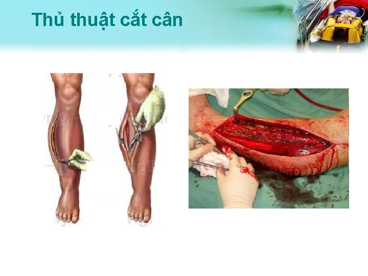 Thủ thuật cắt cân 