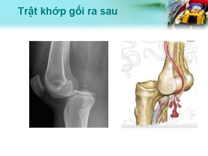 Trật khớp gối ra sau 