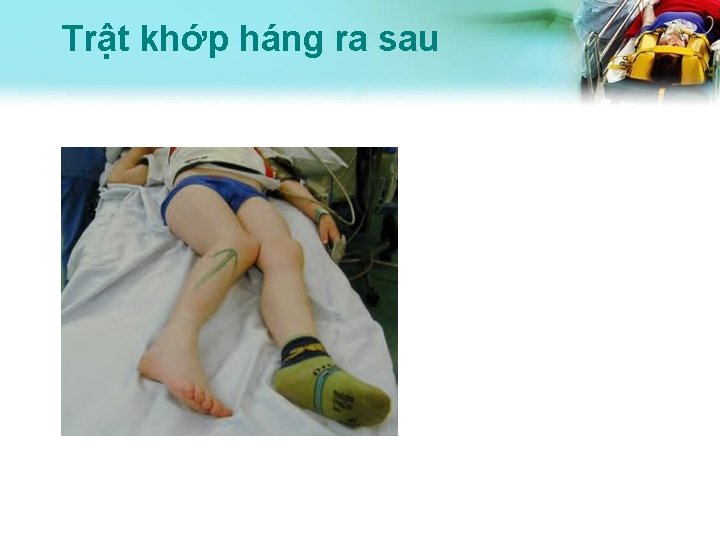 Trật khớp háng ra sau 