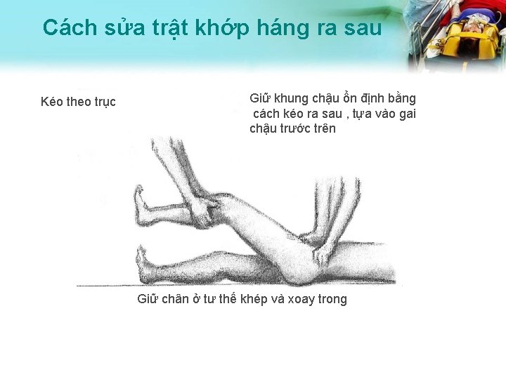 Cách sửa trật khớp háng ra sau Kéo theo trục Giữ khung chậu ổn