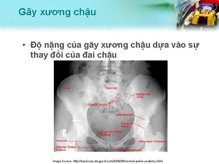 Gãy xương chậu • Độ nặng của gãy xương chậu dựa vào sự thay