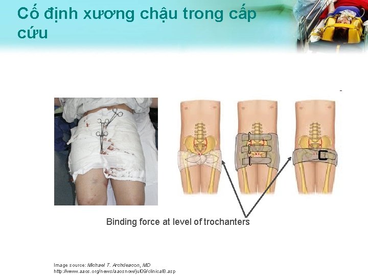 Cố định xương chậu trong cấp cứu Binding force at level of trochanters Image