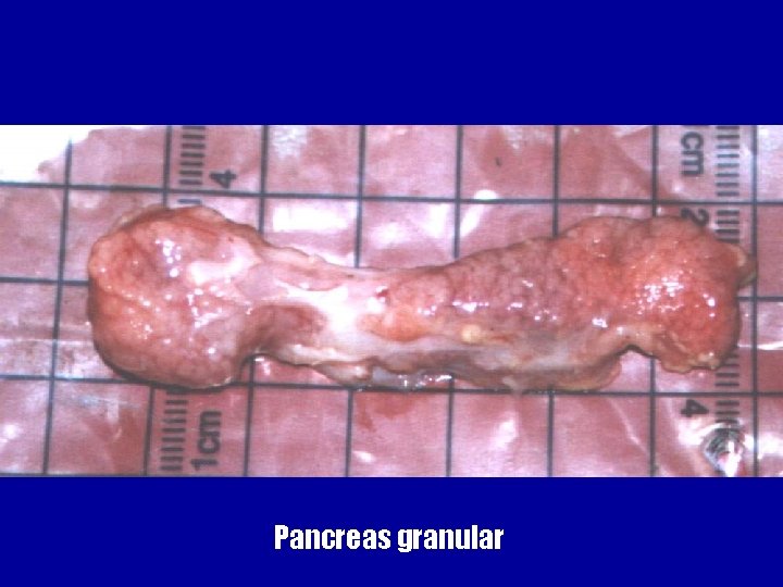Pancreas granular 