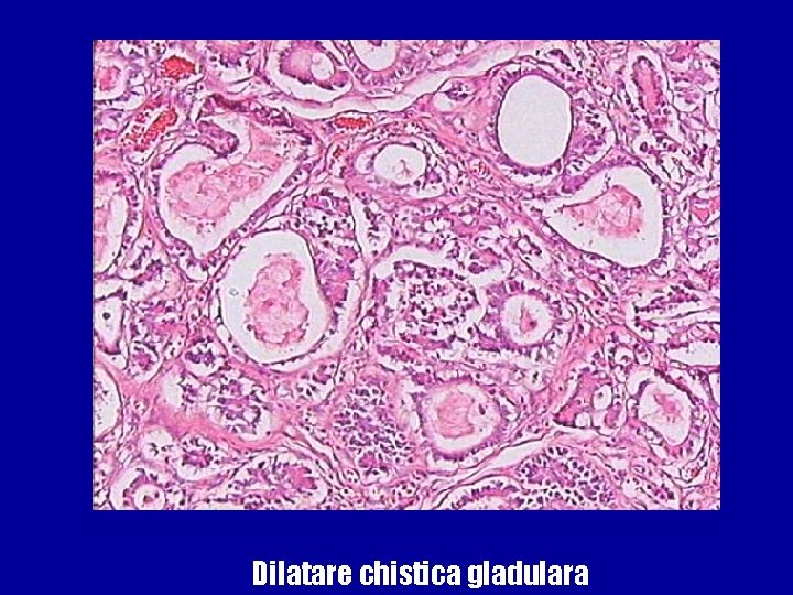 Dilatare chistica gladulara 