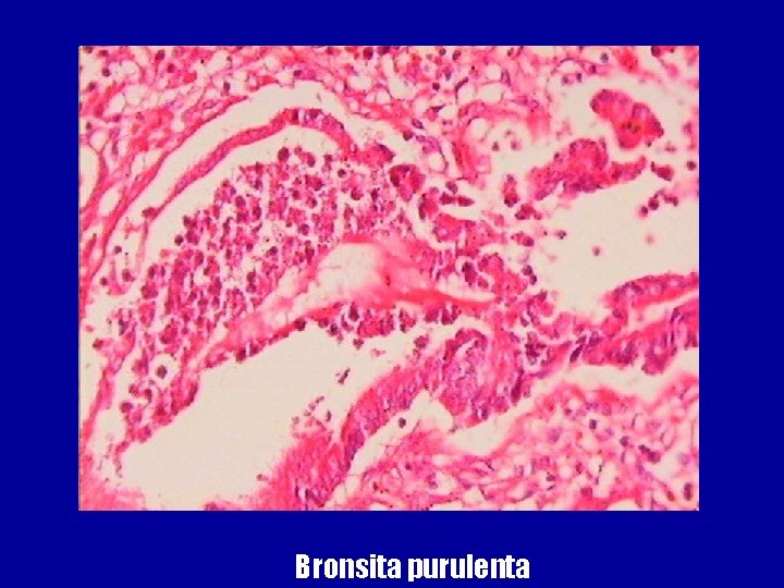 Bronsita purulenta 