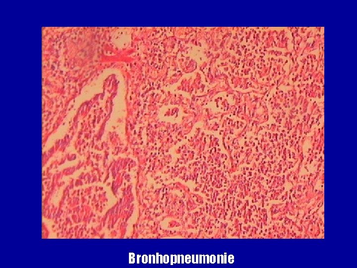 Bronhopneumonie 