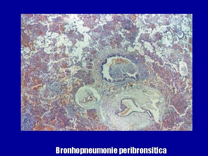 Bronhopneumonie peribronsitica 