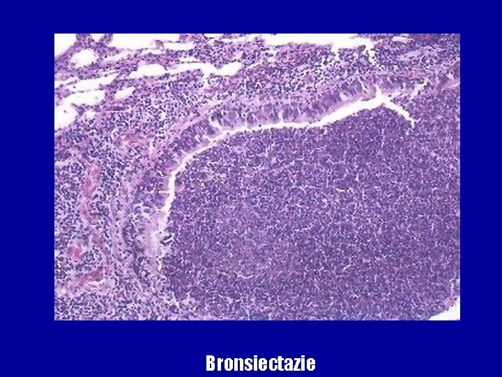 Bronsiectazie 