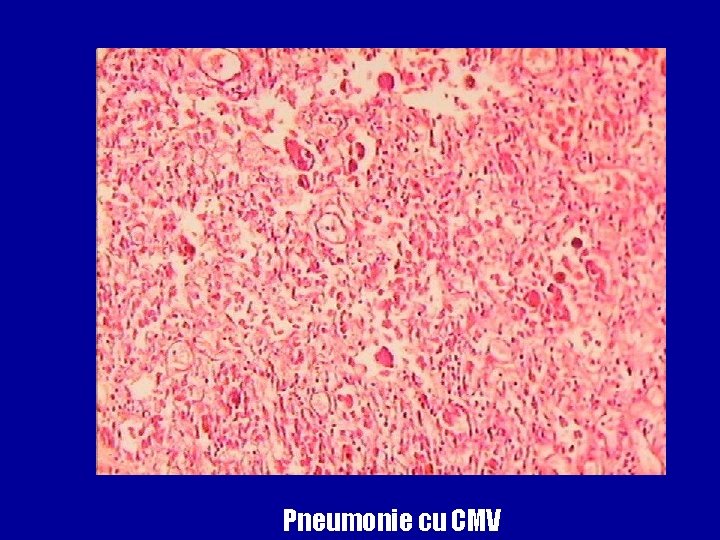 Pneumonie cu CMV 