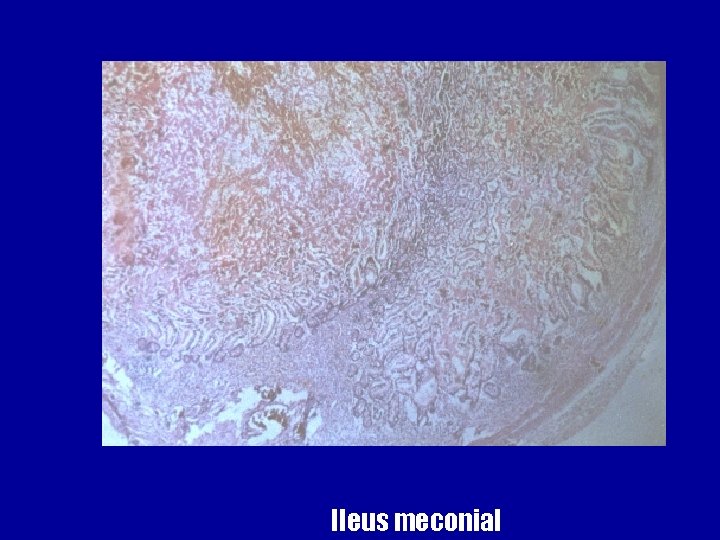 Ileus meconial 