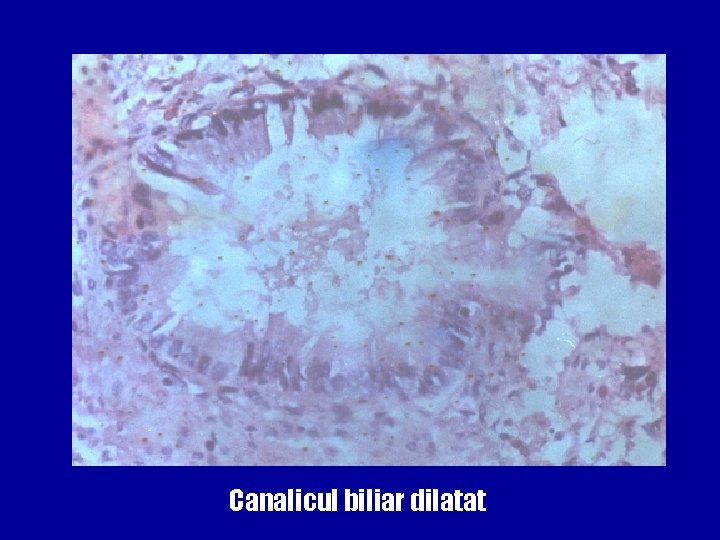 Canalicul biliar dilatat 