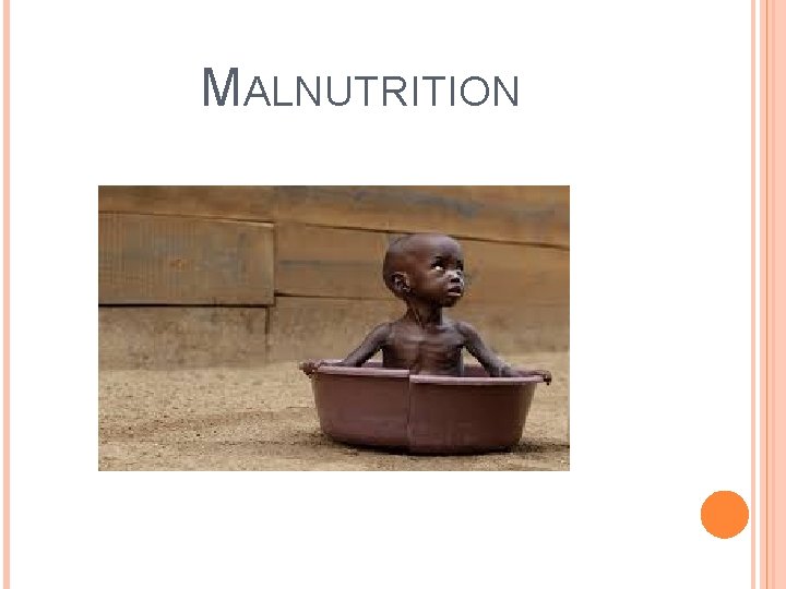 MALNUTRITION 