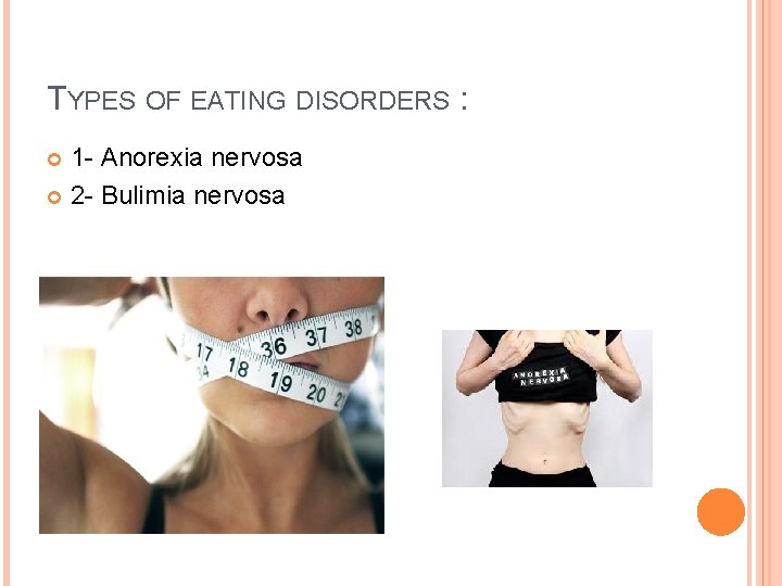 TYPES OF EATING DISORDERS : 1 - Anorexia nervosa 2 - Bulimia nervosa 