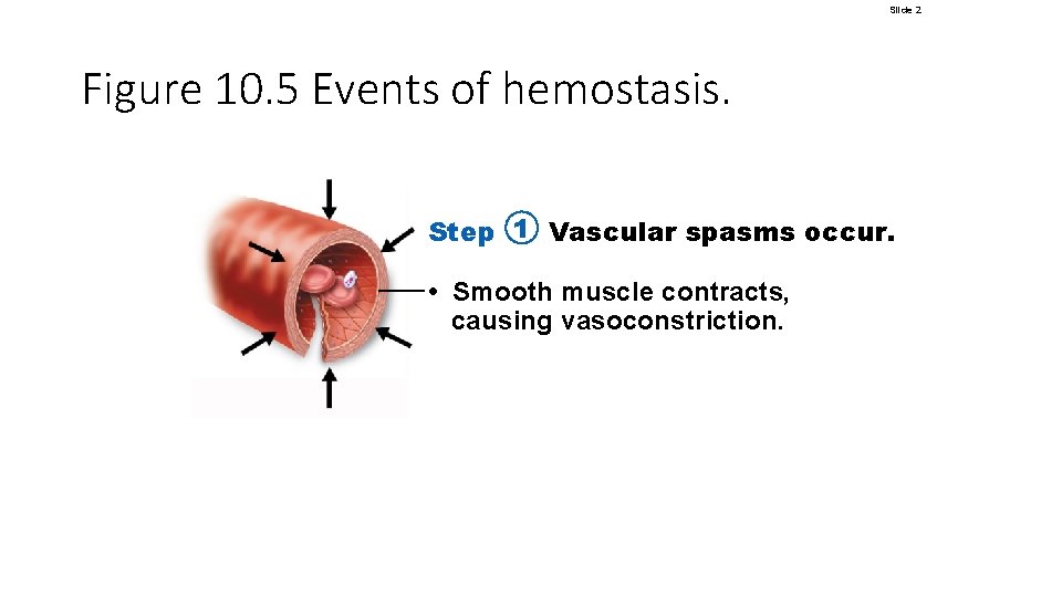 Slide 2 Figure 10. 5 Events of hemostasis. Step 1 Vascular spasms occur. •