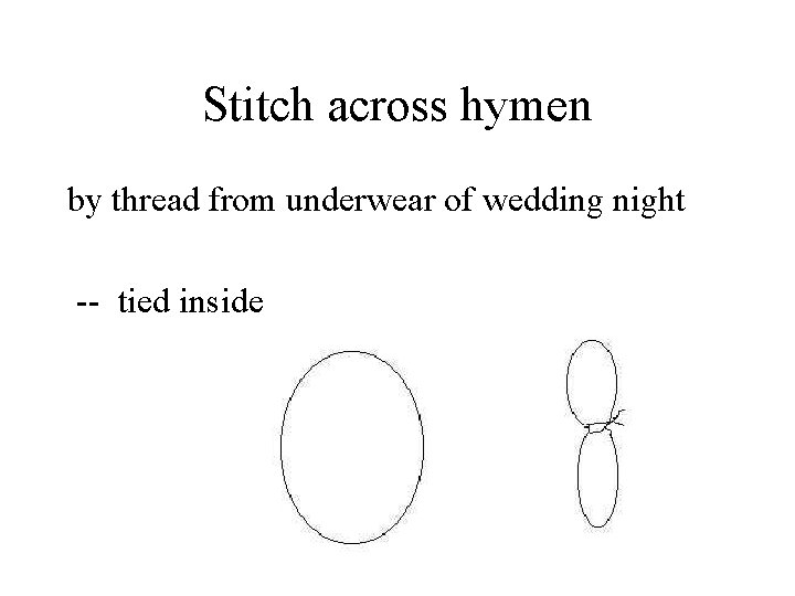 Stitch across hymen by thread from underwear of wedding night -- tied inside 