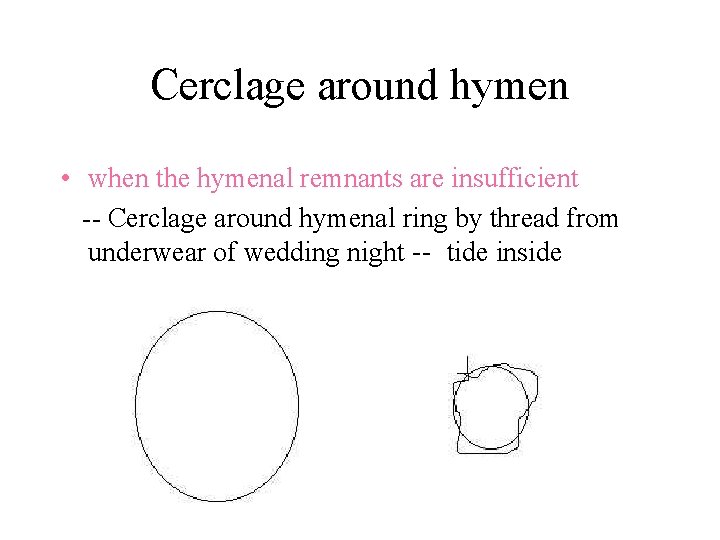 Cerclage around hymen • when the hymenal remnants are insufficient -- Cerclage around hymenal