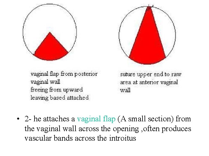  • 2 - he attaches a vaginal flap (A small section) from the