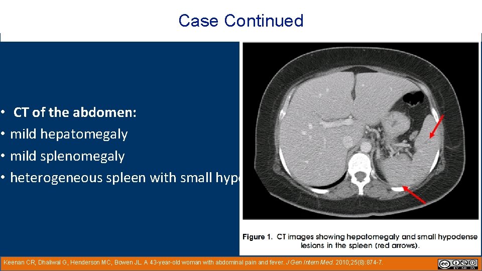 Case Continued • CT of the abdomen: • mild hepatomegaly • mild splenomegaly •