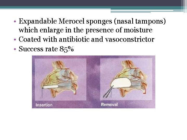  • Expandable Merocel sponges (nasal tampons) which enlarge in the presence of moisture
